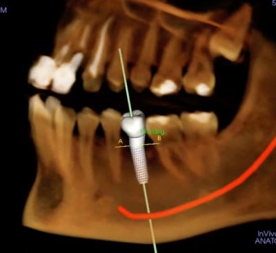Implant imaging- Using CBCT Scan