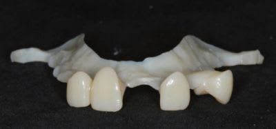 Removable Partial Denture: A Clinician’s Guide